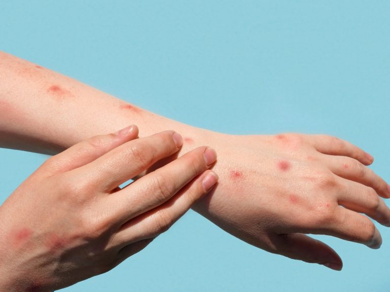 AM: segue em investigação caso suspeito de monkeypox