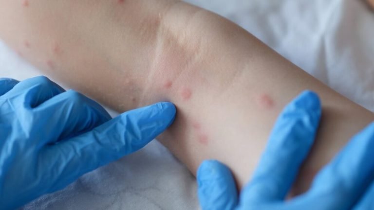 A Secretaria de Estado de Saúde do Amazonas (SES-AM) confirmou, nessa quinta-feira (11), a transmissão local da varíola dos macacos (monkeypox) no estado
