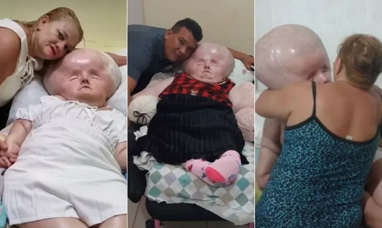 Com tempo de vida estimado em 3 meses, brasileira com hidrocefalia completa 29 anos