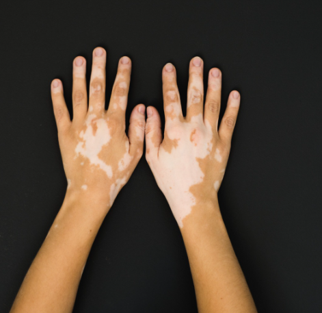 Vitiligo: em seis meses 118 casos são diagnosticados em Manaus. Conheça sintomas e tratamento
