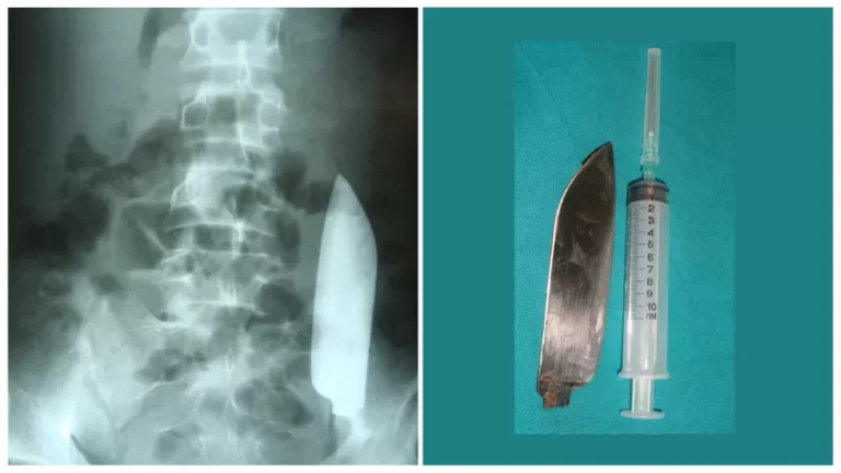 Jovem é esfaqueado e sobrevive após ficar com lâmina presa dentro do corpo