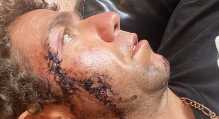 Em praia, sufista é mordido por tubarão no rosto e leva 18 pontos