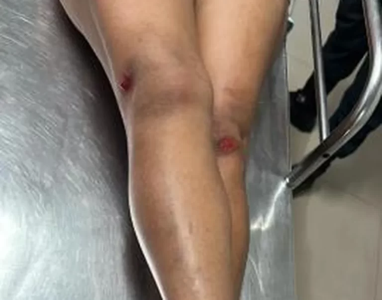 Mulher é agredida com socos e tijoladas após negar fazer programa por R$ 10 em RR