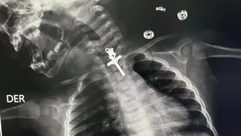 Bebê de 10 meses é operado no Peru após engolir crucifixo