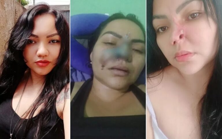 “Não se preocupe, você vai ficar maravilhosa”, disse dentista que necrosou nariz de paciente