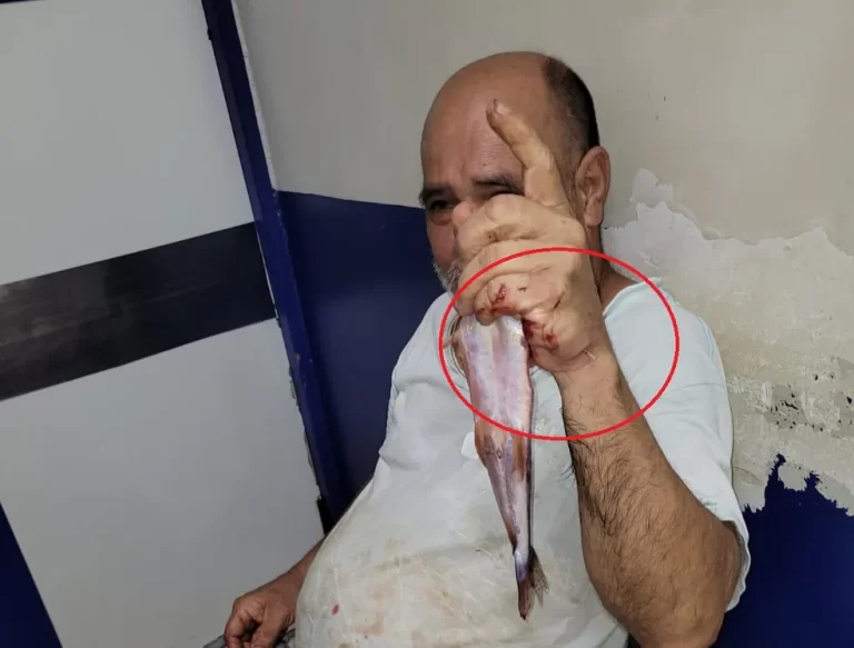 VÍDEO: Idoso tem a mão perfurada por ferrão de peixe bagre, em RO