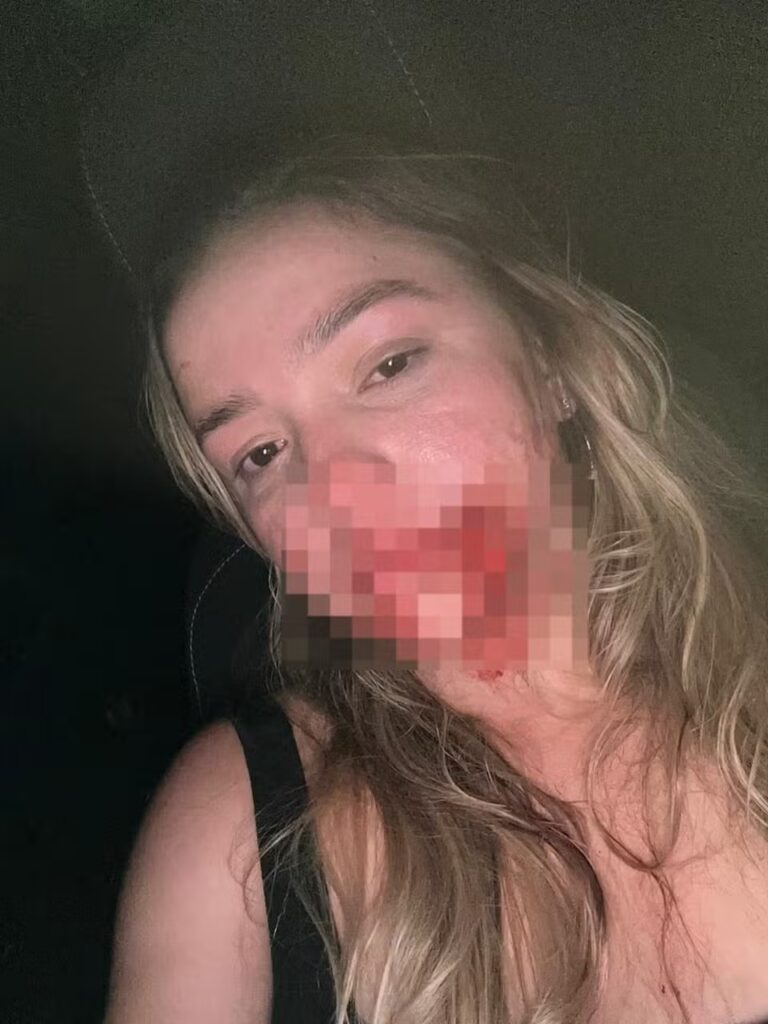 VIDEO: “Cortou de um lado a outro do meu rosto”, diz modelo que acusa síndico de agressão em Teresina