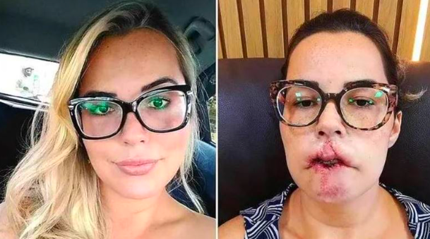Mulher perde o lábio superior após fazer preenchimento com produto errado