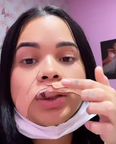 Influencer tem parte do lábio arrancado ao tentar beijar cachorro no Piauí