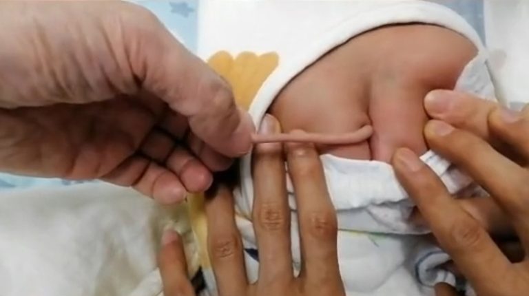 “Bebê Goku”? China registra caso de recém-nascido com cauda de 10 centímetros