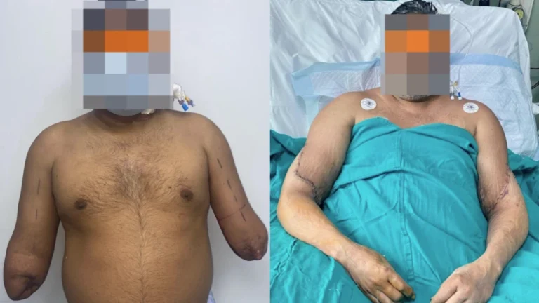 Homem passou por transplante de mãos Reprodução/ Redes sociais