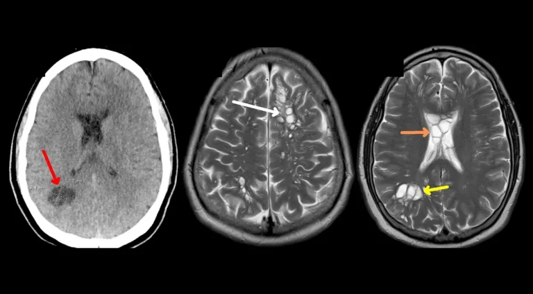 Um homem, 52 anos, começou a ter muitas dores de cabeça, que ficavam cada vez piores. Os médicos descobriram que ele tinha
