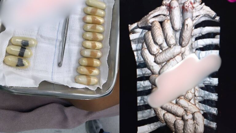 Mulher é hospitalizada em Manaus com estômago cheio de drogas Mulher é hospitalizada em Manaus com estômago cheio de drogas