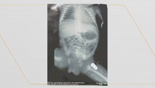 Grávida é atingida por tiro durante assalto e bala fica alojada na perna do bebê, no Maranhão
