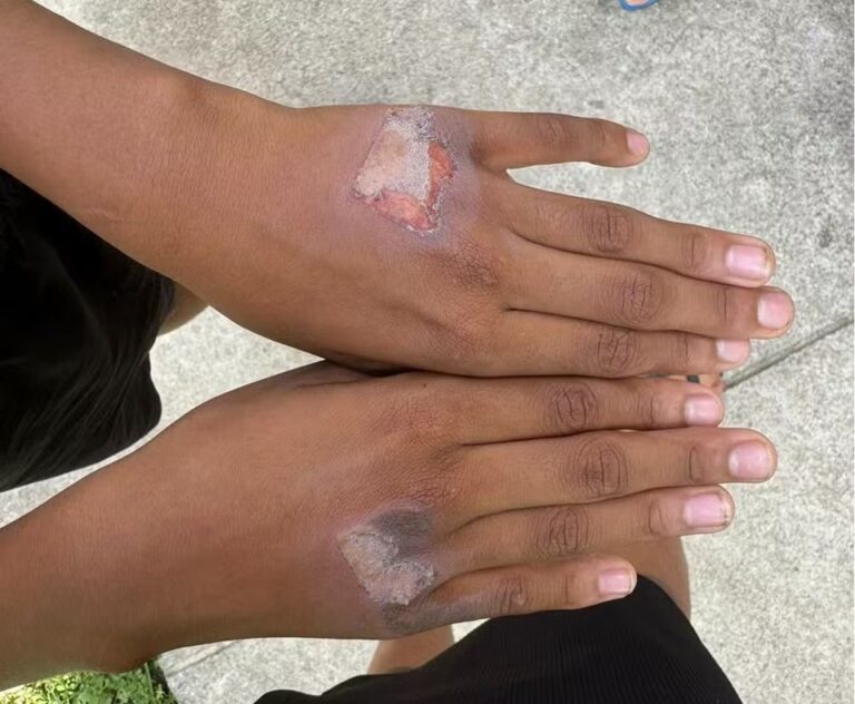 PE: Mãe é investigada por suspeita de queimar mãos do filho com chapinha: "Comeu iogurte sem permissão"