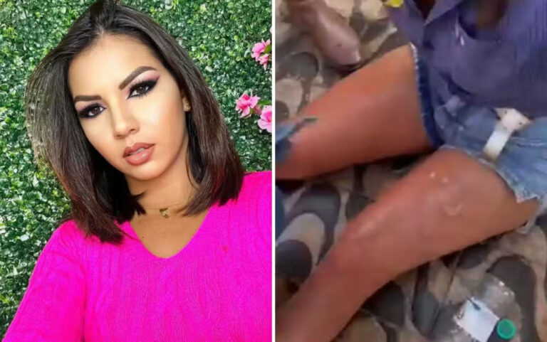 VÍDEO: “Sentimos a ardência e saímos correndo”, diz influenciadora após acidente em que mulher usou álcool em churrasqueira
