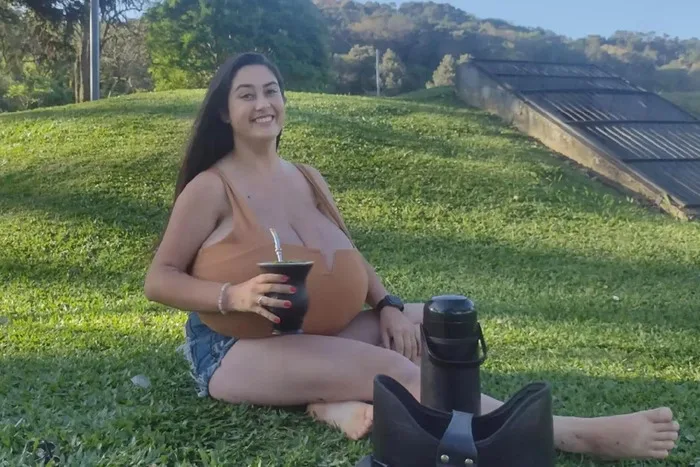 Estudante é diagnosticada com "gigantomastia" e retira 10 kg das mamas em cirurgia