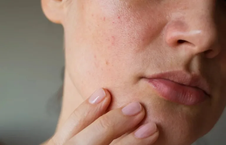 Como controlar a oleosidade da pele: dicas essenciais para manter a pele sequinha