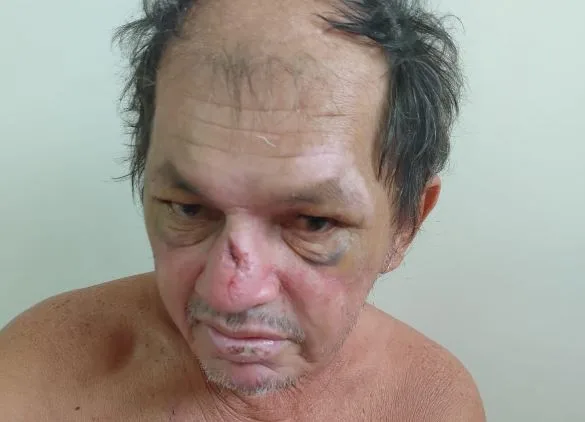 Paciente Charles de Souza Tavares. (FOTO: Divulgação)