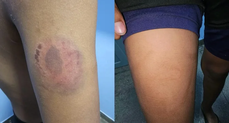 Homem torturava menina de 15 anos com alicate, beliscões e mordidas em cárcere privado