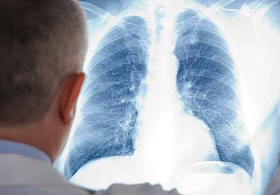 Dia Mundial da Tuberculose: Veja como diagnosticar a doença