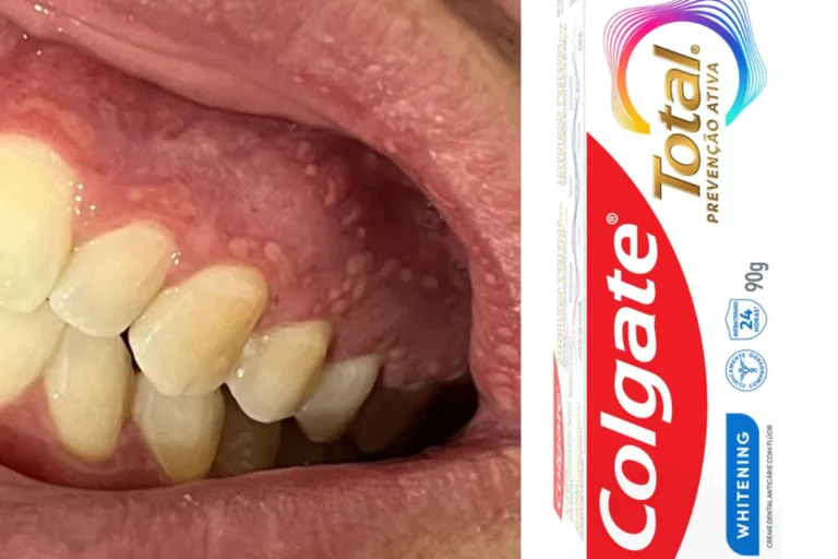 Anvisa interdita temporariamente creme dental da Colgate - (Foto: Arquivo Pessoal e Colgate Divulgação).