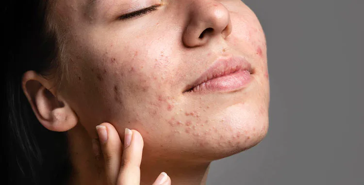 Conheça 9 alimentos vilões no combate a acne