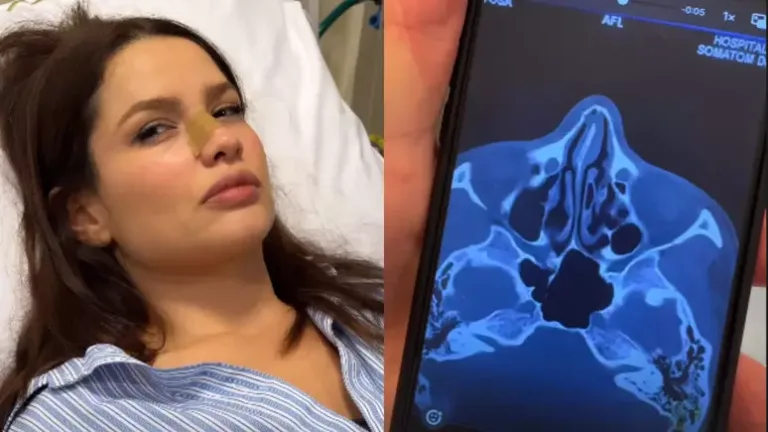 Juliette sofre acidente doméstico e vai parar no hospital: "Acabei de bater a boca e o nariz na janela