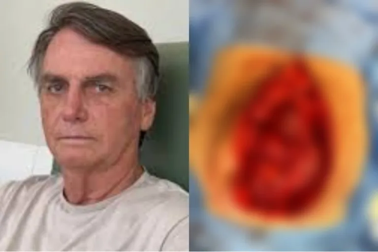 IMAGEM FORTE: Bolsonaro posta foto do intestino exposto e choca web