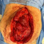 Bolsonaro-intestino-exposto-foto