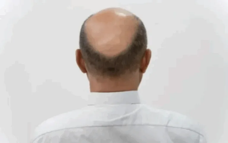 Os homens geralmente perdem o cabelo no topo da cabeça - (Foto: Divulgação).