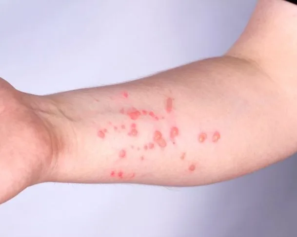 Amazonas já registrou 35 casos de mpox