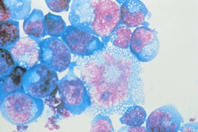 Células humanas infectadas com HIV.