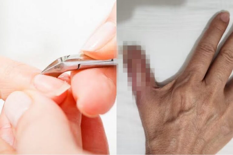 Mulher perde parte do dedo após fazer as unhas em salão de beleza