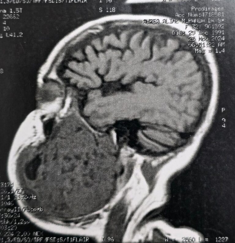 Tumor de mais de 2 kg é retirado de mandíbula de paciente em Manaus
