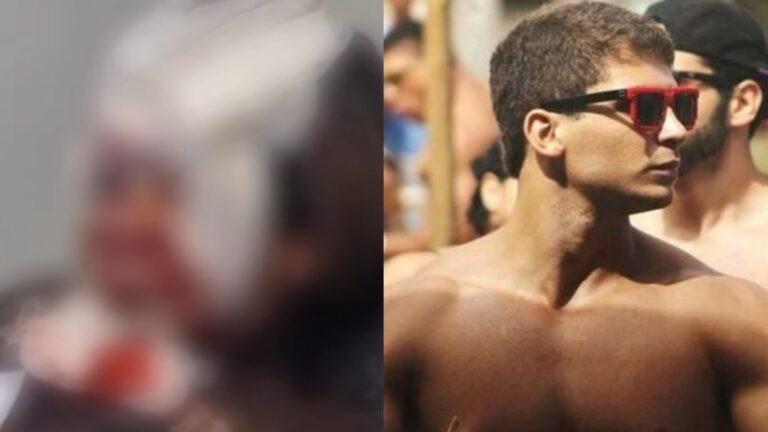 Veja como está mulher que teve múltiplas fraturas após ser atingida com 61 socos por namorado em elevador em Fortaleza