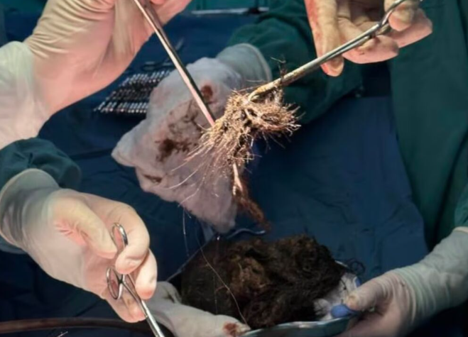 Adolescente de 15 anos tem bola de cabelo de 2 quilos retirada do estômago na China