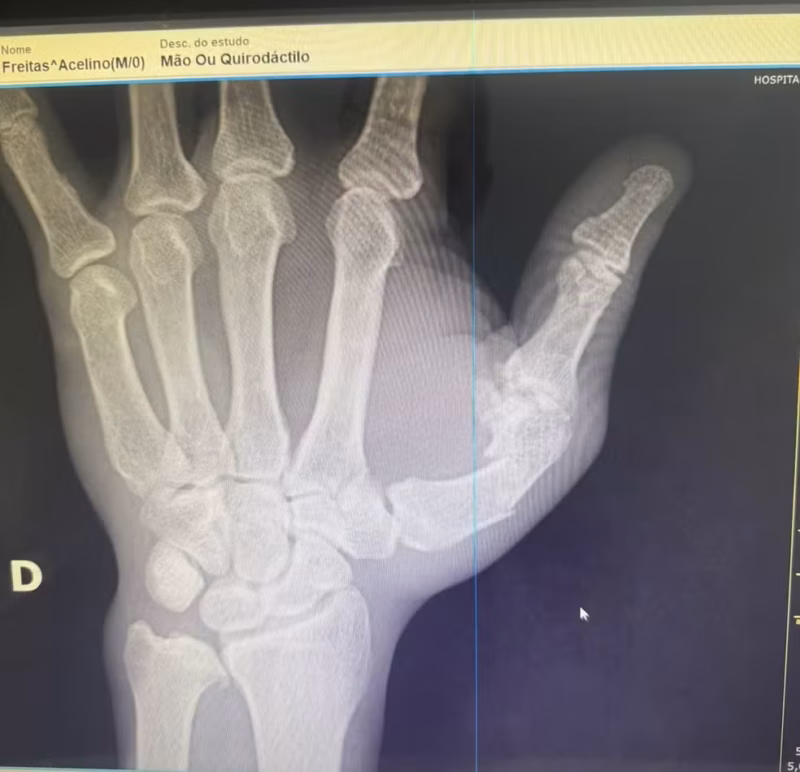 Fratura na mão de Popó (Foto: Divulgação)