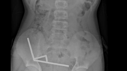 Menino de 13 anos perde parte do intestino após engolir mais de 80 ímãs Menino de 13 anos perde parte do intestino após engolir mais de 80 ímãs