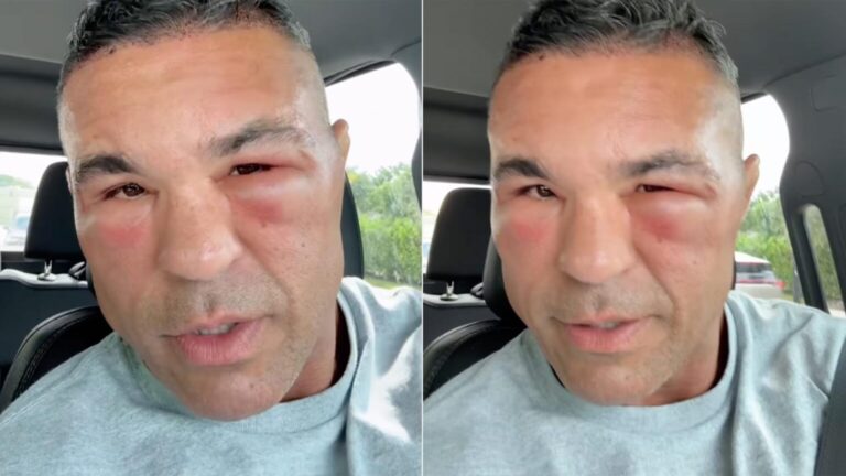 Vitor Belfort surge com rosto inchado após procedimento famoso; descubra qual Vitor Belfort surge com rosto inchado após procedimento famoso; descubra qual