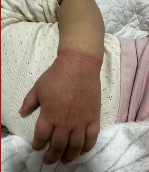 Elástico de cabelo quase faz menina de 2 anos perder o braço em Manaus