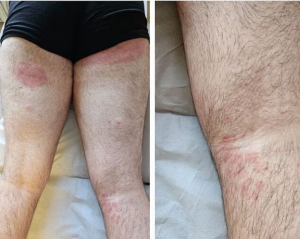 Superfungo que ataca axilas e nádegas avança no Reino Unido e acende alerta; tratamento contra infecção é extremamente tóxico