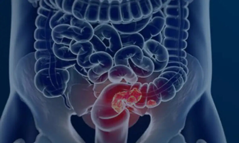 Câncer colorretal: maioria dos pacientes é diagnosticado em estado avançado, diz estudo