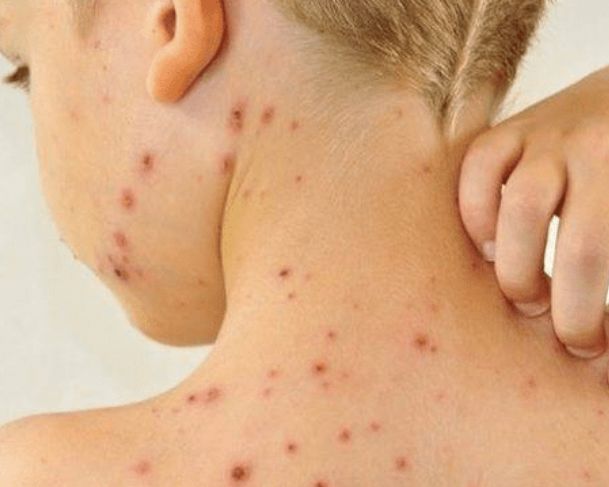 Américas perdem status de região livre do sarampo; veja qual a situação do Brasil