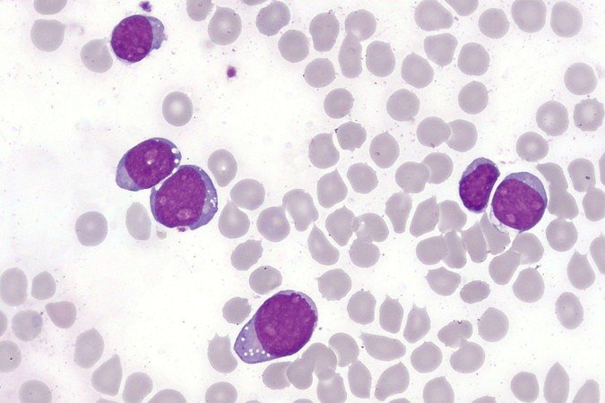 Células modificadas vencem leucemia agressiva e colocam pacientes em remissão histórica Células modificadas vencem leucemia agressiva e colocam pacientes em remissão histórica