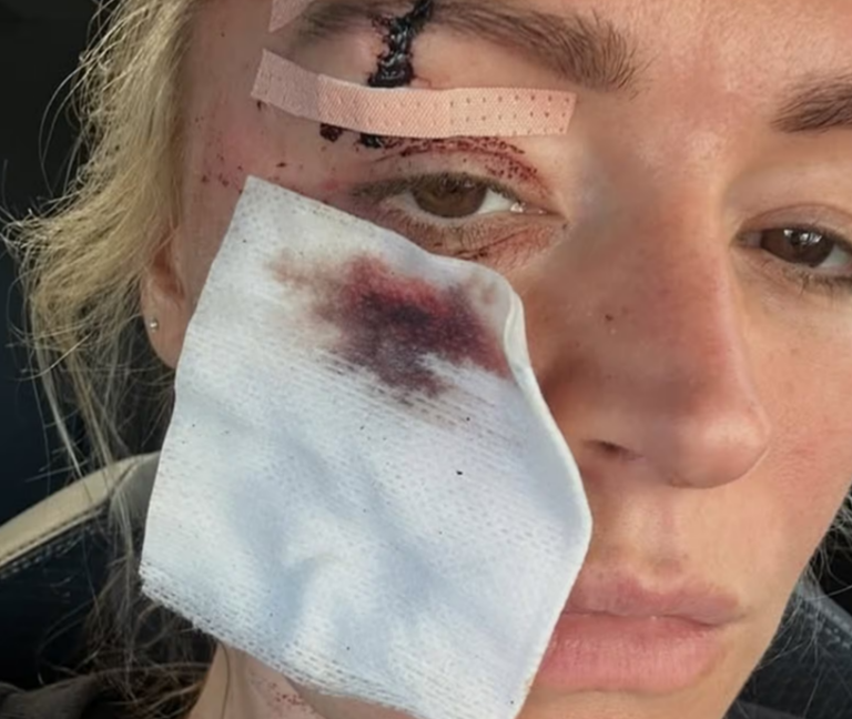 Apresentadora britânica fala sobre acidente em casa e recuperação pós-cirurgia