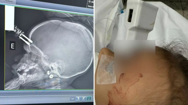 Queda da cama deixa carregador cravado na testa de criança de 1 ano