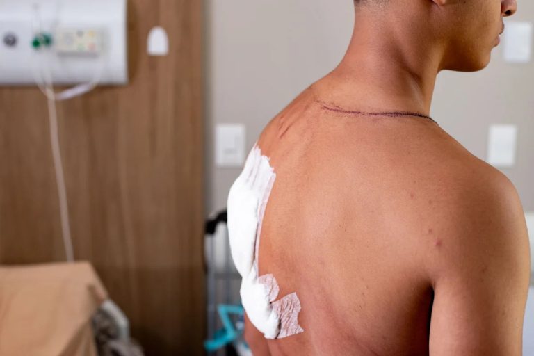 Jovem que teve costas rasgadas por raio em ato de Nikolas Ferreira recebe alta