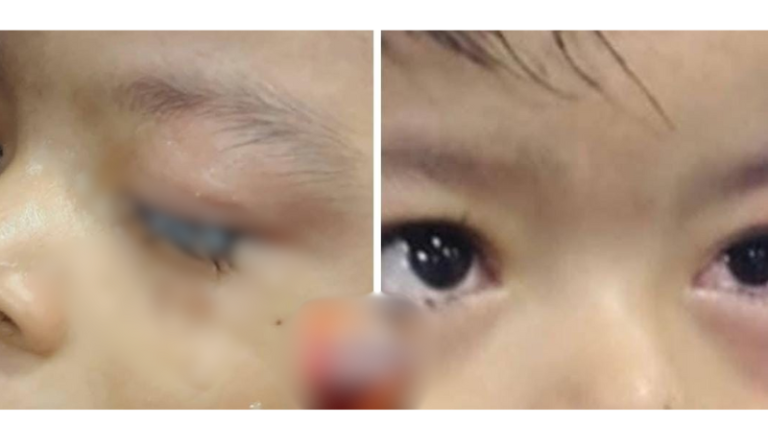 Criança de 2 anos cola próprios olhos e deixa família desesperada em Parintins