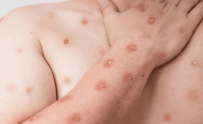 Santos confirma dois casos de Mpox